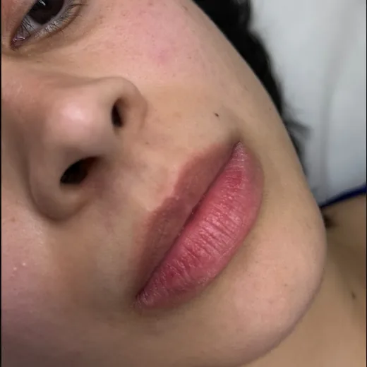 Antes — Preenchimento Labial